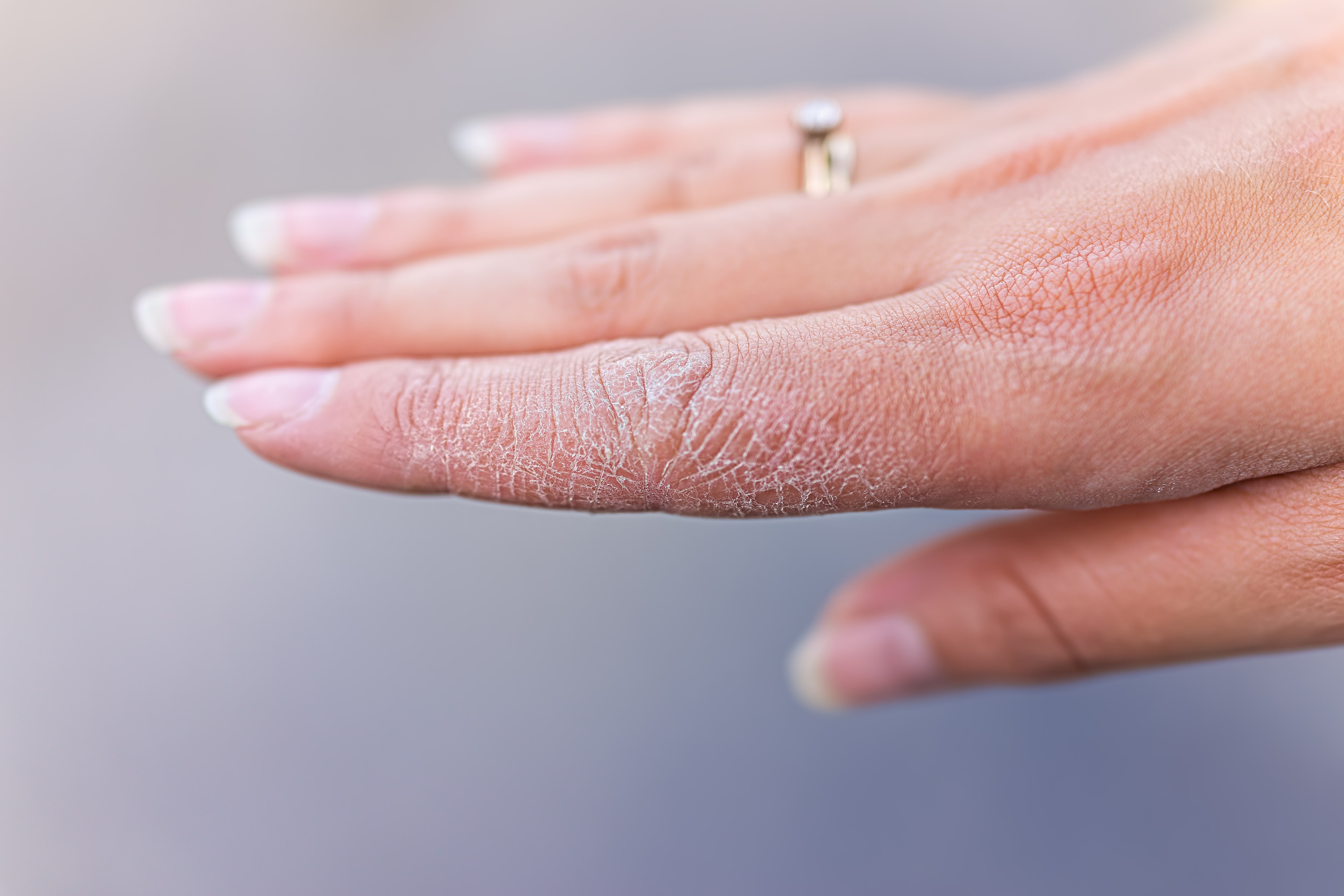 5 Immediate Fixes For Dry Hands Neutrogena 